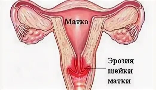 Болит цервикальный канал