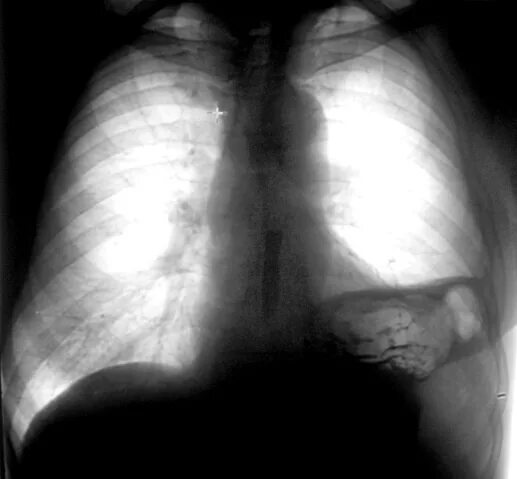 После лобэктомии легкого. Лобэктомия легкого рентген. Синдром тотального затемнения. Лобэктомия на рентгенограмме.