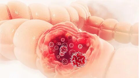 Colorectal cancer