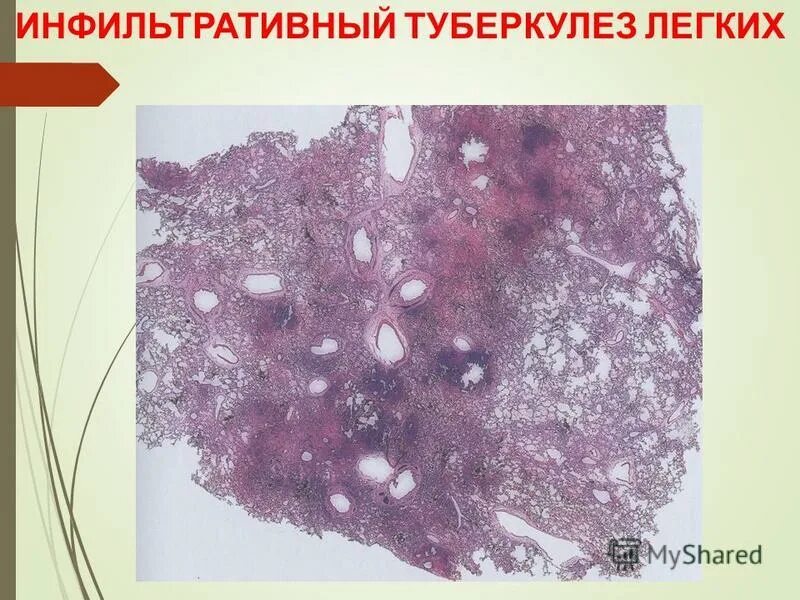 Ru туберкулез. Милиарный туберкулез гистология. Милиарный туберкулез патанатомия. Туберкулез легкого гистология. Казеозная пневмония гистология.