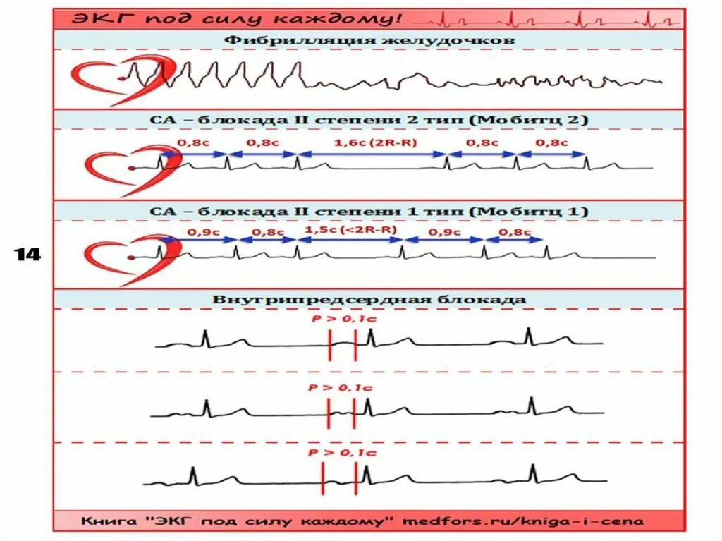 Предсердная блокада. Внутрипредсердная блокада на ЭКГ. Внутрипредсердная блокада 3 степени ЭКГ. Внутрипредсердная блокада 2 степени на ЭКГ. Внутрипредсердная блокада 1 степени на ЭКГ что это такое.