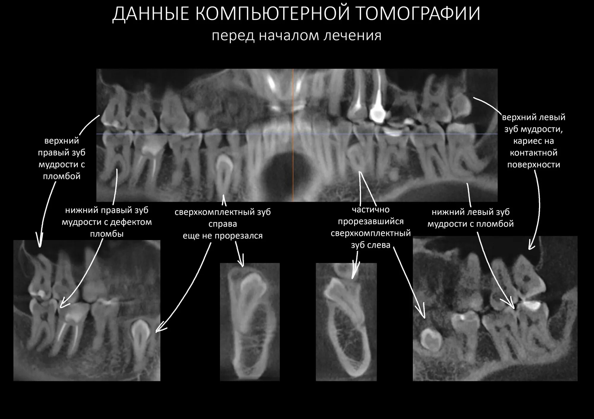 Как правильно подготовиться к установке брекетов (брекет системы)