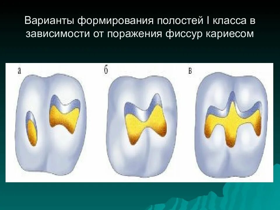 Пломбирование полостей 4 класса. Пломбирование полостей 4 класса