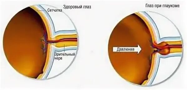 Повышение внутриглазного давления. Глазное давление симптомы у женщин. Глазное давление признаки и симптомы.