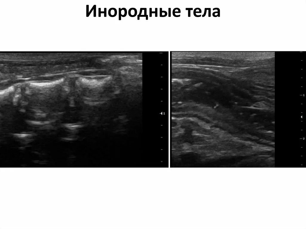 На УЗИ посторонние предметы. Линейное инородное тело у кошек УЗИ.