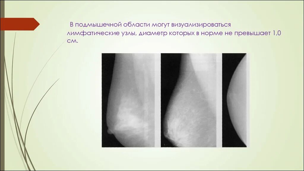 Норма аксиллярных лимфоузлов. Аксиллярная область молочной железы лимфоузлы. Подмышечные лимфатические узлы норма. Размеры подмышечных лимфатических узлов. Подмышечные лимфатические узлы нормальные Размеры.