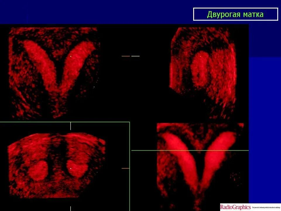 Двурогая седловидная матка. Двурогая седловидная матка. Как выглядит двурогая матка. Как выглядит двурогая матка. Двурогая матка шейка влагалище.