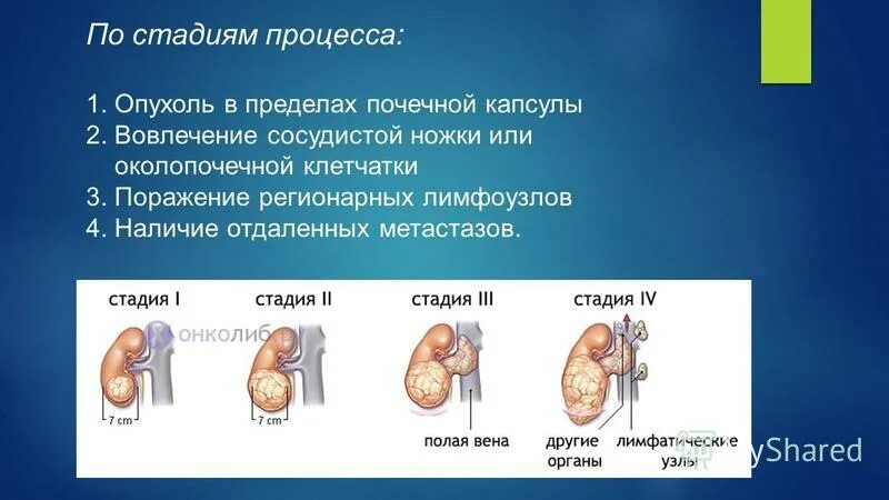 Опухоли почек классификация. Рак почки причины