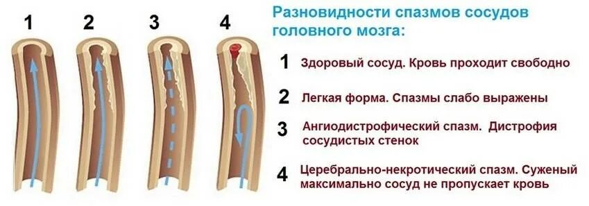 Причины сужения головного мозга. Ангиоспазм сужение сосудов.