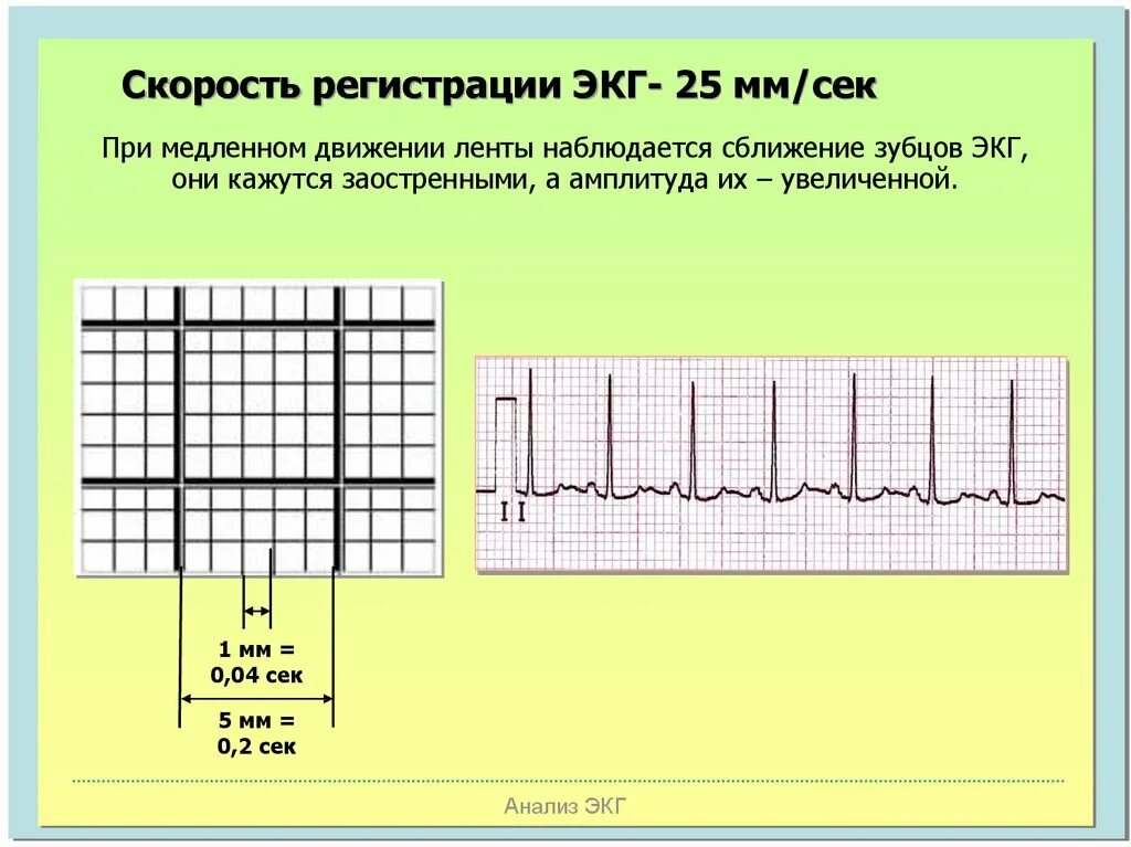 Экг для чего. Скорость записи экг 25 мм с. экг 50 мм/с &amp; 10 мм/мв 1найти протокол электрокардиографии. нормальная экг 50 мм/с. 50 мм сек экг.