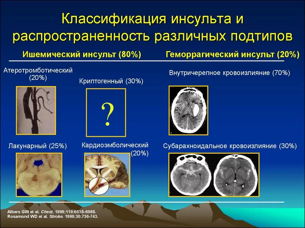 Криптогенный инсульт