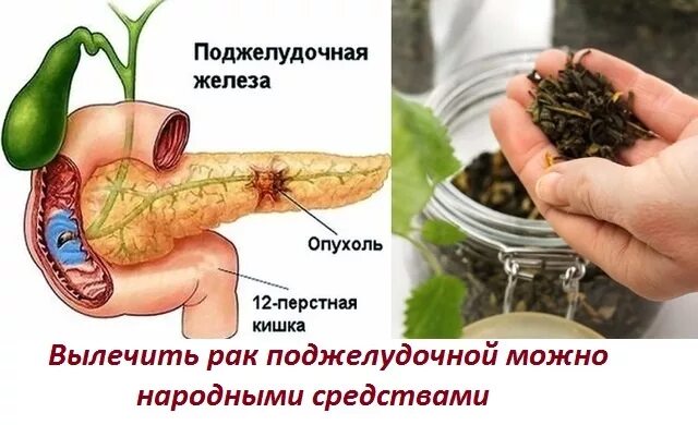 Можно ли удалить поджелудочную железу полностью