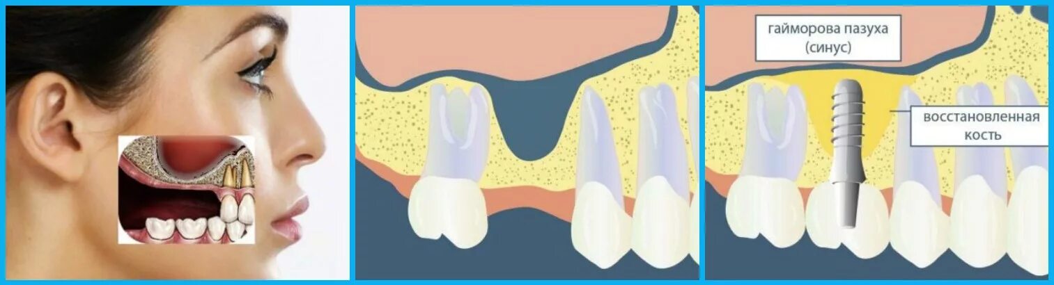 Синус-лифтинг гайморова пазуха. Синус-лифтинг (костная пластика, остеопластика) закрытый. Синус-лифтинг костная пластика. Костная пластика (наращивание кости). Синус десны