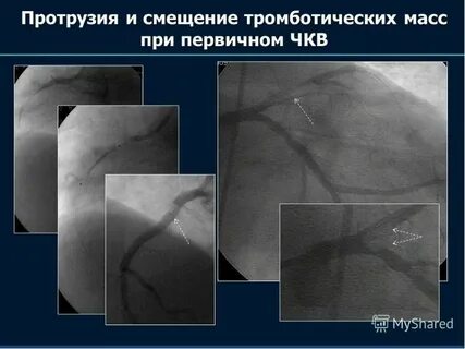 Инвалидность после инфаркта миокарда и стентирования