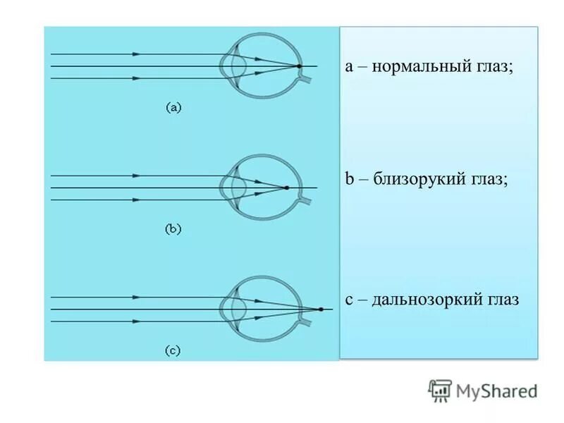 Дальнозоркость линзы двояковыпуклые