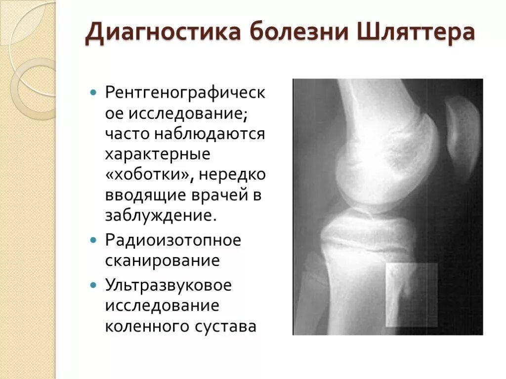Код мкб шляттера. Осгуд шляттера болезнь рентген. остеохондропатия бугристости большеберцовой кости. рентген коленного сустава болезнь осгуда шлаттера. осгуд шляттера болезнь большеберцовой кости.