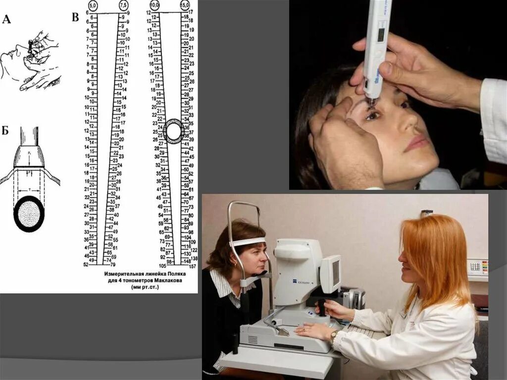 Внутриглазное давление по маклакову. Тонометрия ВГД по маклакову. Измерение ВГД по маклакову алгоритм. Линейка для измерения внутриглазного давления по маклакову. Аппарат для измерения ВГД.