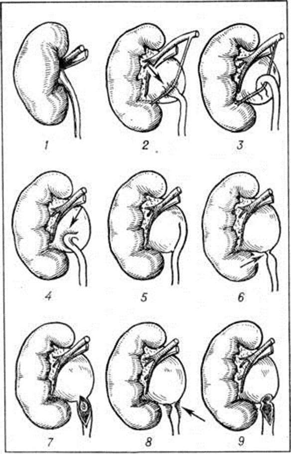 Перегиб мочеточника. Причины врожденного гидронефроза. Гидронефроз чашечно лоханочной системы.