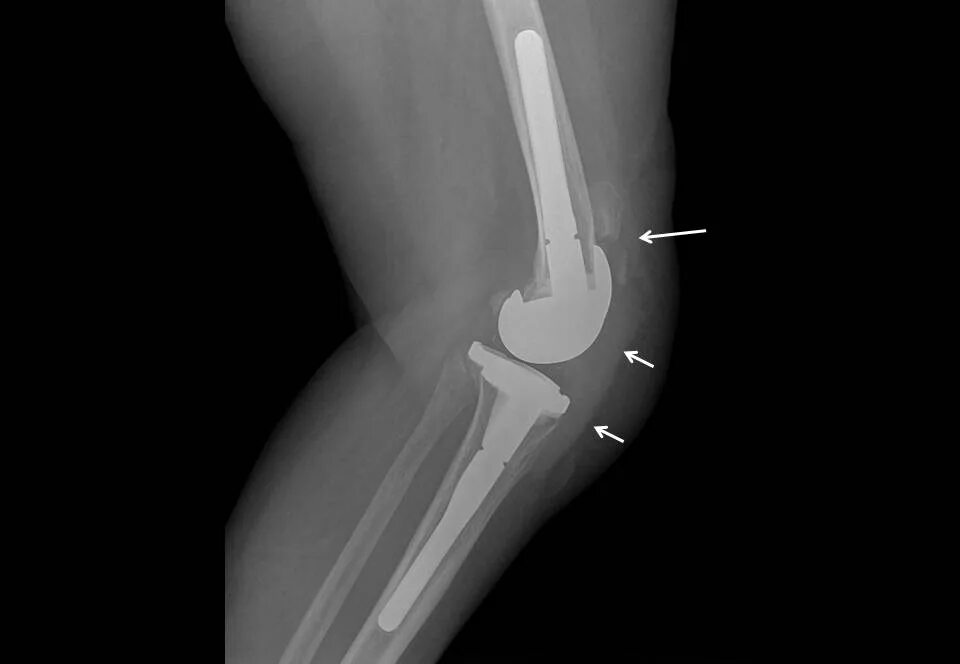 Мрт после эндопротезирования. Эндопротез коленного сустава рентген. Нестабильность эндопротеза коленного сустава рентген. Тотальный эндопротез коленного сустава рентген. Рентген коленного сустава после эндопротезирования.