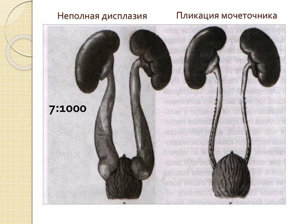 Развитие мочеточников. Врожденные аномалии развития мочевыделительной системы. Аномалии развития мочевых путей. Врожденные патологии выделительной системы. Пороки развития органов мочевыделительной системы.