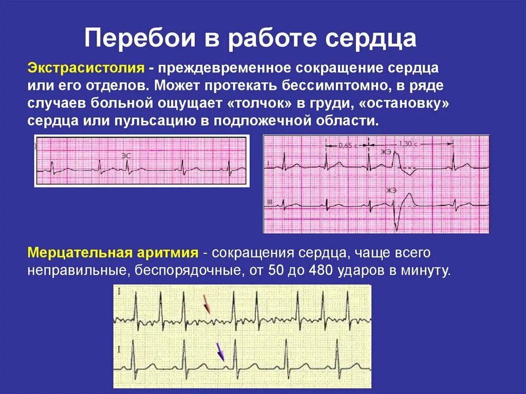 Сильно стучит сердце что делать. Сердцебиение и перебои в работе сердца. Перебои в сердцебиении причины. Перебои в сердце на ЭКГ. Сердце работает с перебоями.