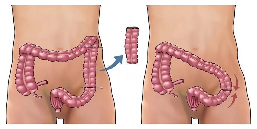 Опущение толстой кишки. Опущение кишечника колоноптоз. Трансверзоптоз ободочной кишки. Гемиколэктомия ободочной кишки. Симптомы операция кишечнике