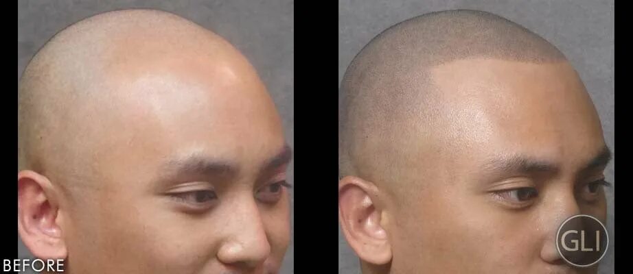 микропигментирование волос на голове. татуаж на голове для мужчин фото. трихопигментация скальпа. татуаж головы мужчины. татуаж на голове для мужчин.