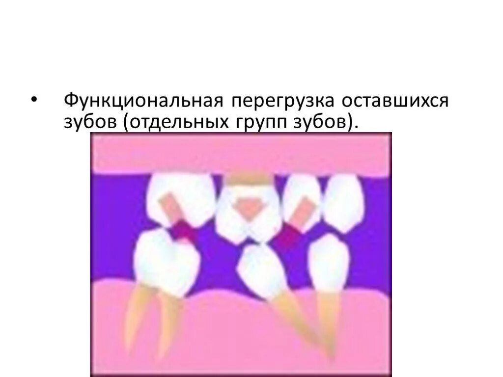 Функциональная перегрузка. Функциональная перегрузка зубов. перегоузка щуьов функциональная перегрузка. функциональная перегрузка пародонта оставшихся зубов. функциональная перегрузка зуба это.