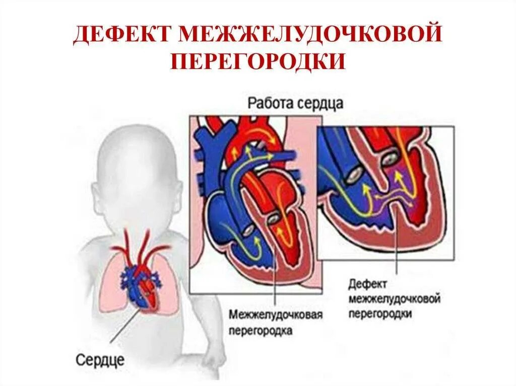 Врожденные пороки сердца дефект межжелудочковой перегородки(ДМЖП). Порок сердца у новорожденного межжелудочковой перегородки. Порок сердца ДМЖП У новорожденных. Врожденный порок сердца дефект межжелудочной перегородки. Гемодинамика у детей