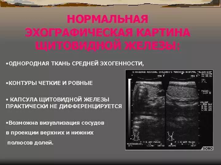 Эхоструктура железы диффузно неоднородная. Эхогенность щитовидной железы. Нормальная эхогенность щитовидной железы. Эхогенность щитовидной железы снижена. Эхоструктура щитовидной железы.