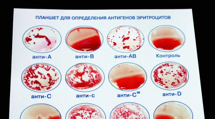 Как отличить кровь. Определить группу крови и резус-фактор. Определение группы крови. Планшет для определения группы крови. Кровь группы крови.