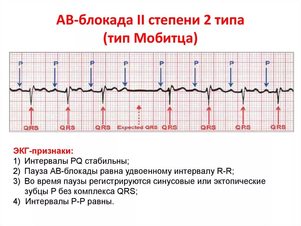 Av блок. ЭКГ атриовентрикулярная блокада Мобиц 2. АВ блокада 2 степени типа Мобитц 2. Av блокада 2 степени 2 типа на ЭКГ. Са блокада 2-й степени ЭКГ.