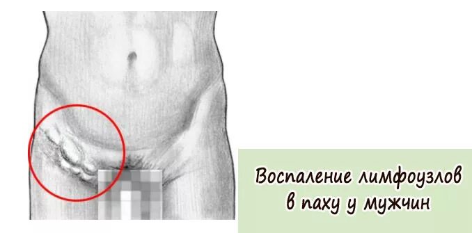 Абсцедирующий паховый лимфаденит. Сифилитический паховый лимфаденит. Паховые лимфоузлы воспаление. Боли в правой области паха