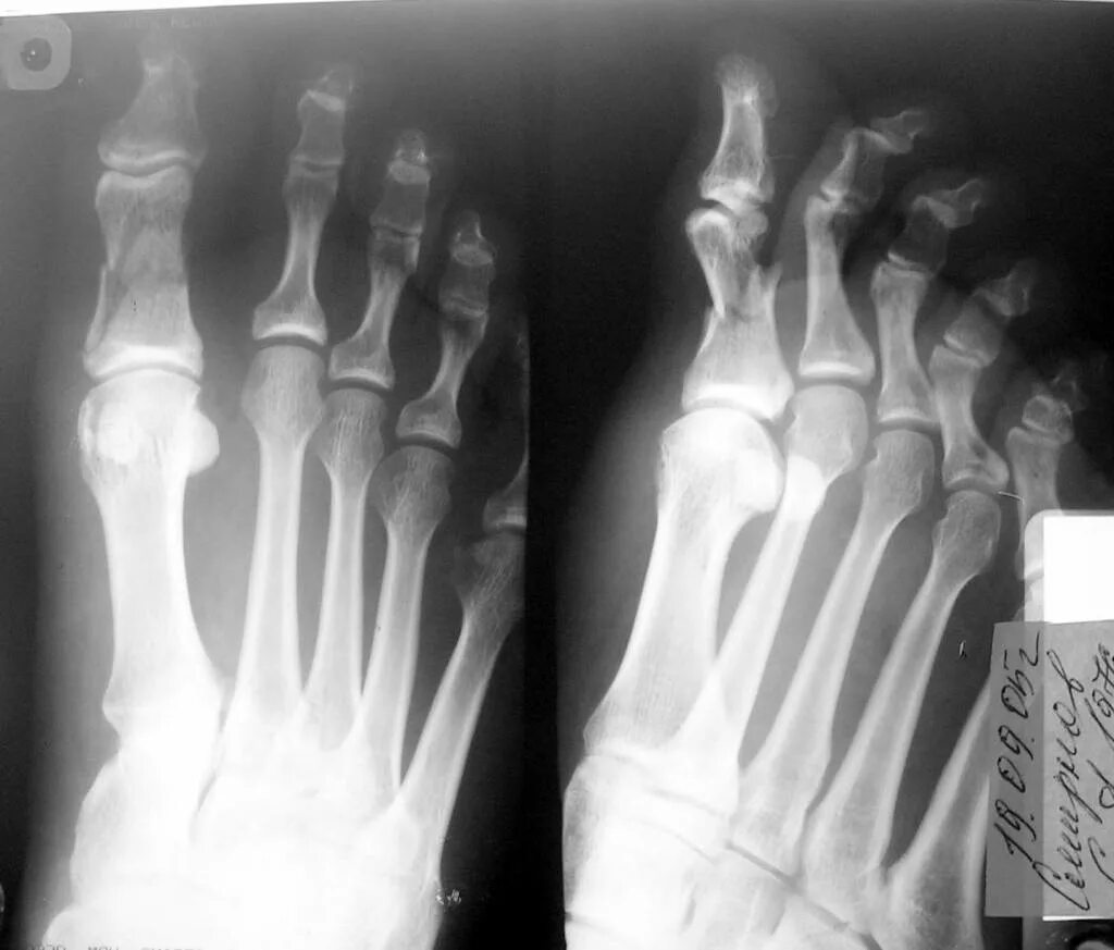 Трещина фаланги. Перелом основной фаланги 1 пальца стопы рентген. Краевой перелом проксимальной фаланги 1 пальца стопы. Перелом основания фаланги 1 пальца левой стопы рентген. Перелом проксимальной фаланги 1 пальца.