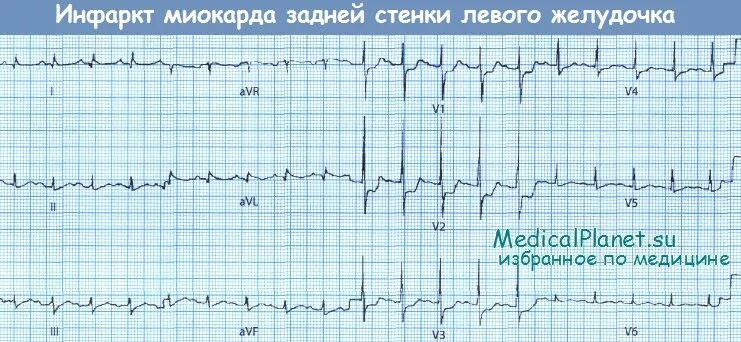 ЭКГ критерии заднего инфаркта миокарда. ОИМ задней стенки ЭКГ. Острый инфаркт миокарда задней стенки левого желудочка ЭКГ. Стенки инфаркта миокарда на ЭКГ.