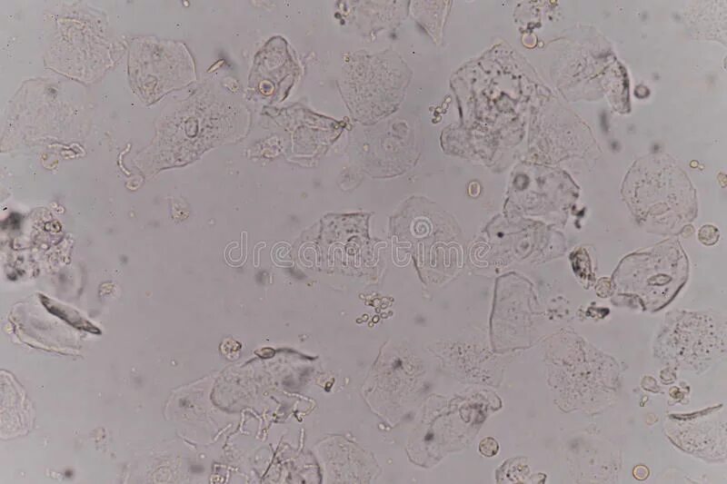 Дрожжевые клетки в моче повышены. Дрожжевые клетки в моче под микроскопом. Дрожжевые клетки на ногтях. Дрожжеподобные клетки на ногтях. Эпителий плоский в моче.