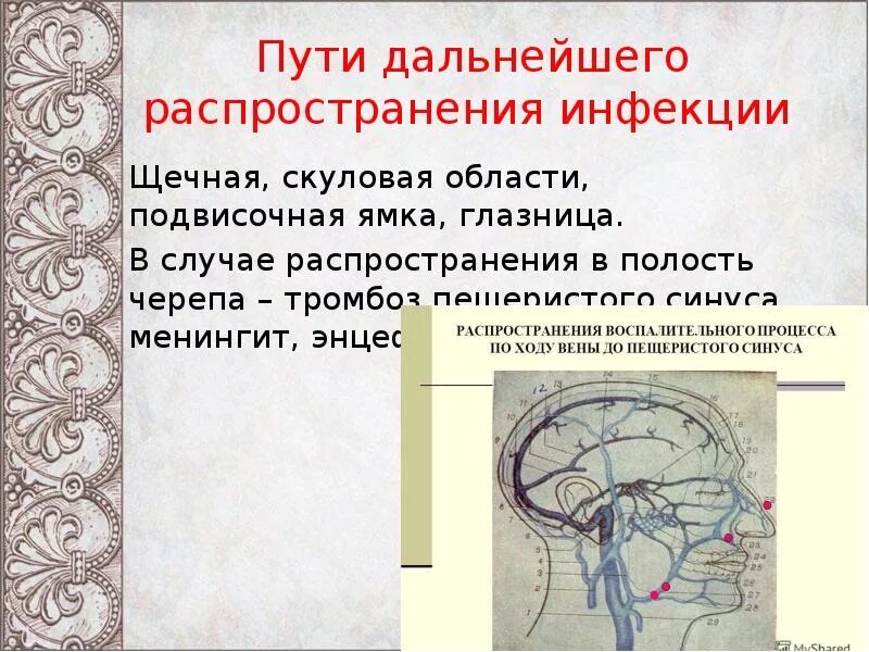 Дальнейшим распределением. Пути распространения инфекции. Тромбоз кавернозного синуса пути распространения инфекции. Пути распространения инфекции в кавернозный синус. Пути распространения инфекции в полости черепа.