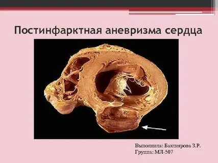 Аневризма сердца