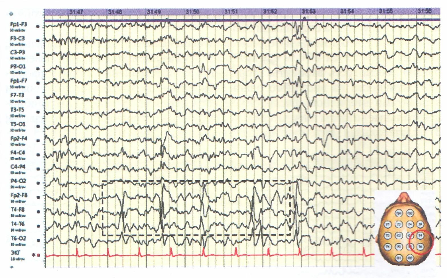 Что значит эпилептиформная активность. Эпилептиформная активность на ЭЭГ. Лямбда волны на ЭЭГ. ЭЭГ при эпилепсии. Региональная эпилептиформная активность у ребенка на ЭЭГ.