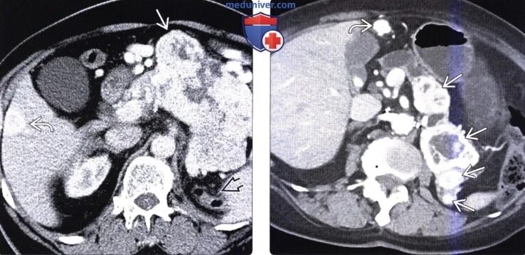 Лимфома поджелудочной железы кт. Метастазы поджелудочной железы на кт. Метастазы поджелудочной на кт. Гиповаскулярные метастазы печени кт.