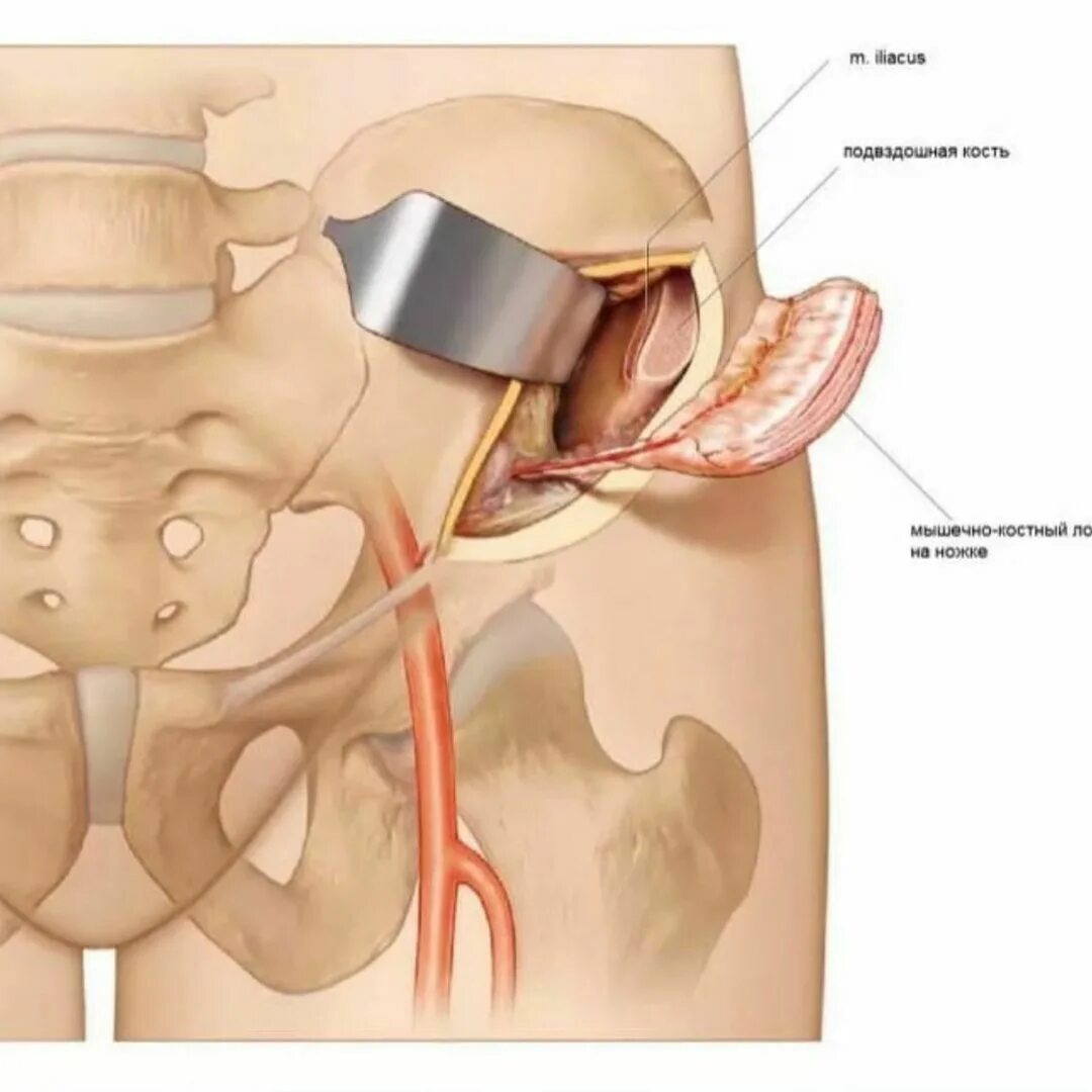 Болит таз мужчины. Лоскут гребня подвздошной кости. Ость гребня подвздошной кости. Резекция левой подвздошной кости. Подвздошная кость гребень.