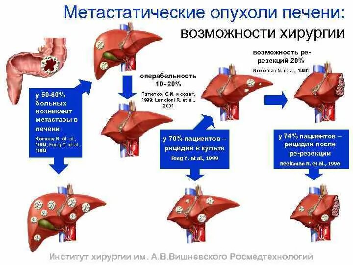 Операции на 4 стадии. Сегменты печени метастазы. Метастатическое поражение печени. Вторичные (Метастатические) опухоли печени. Метатсатические опухоли печень.