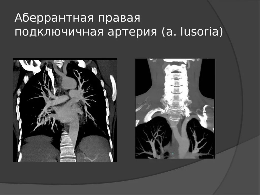 Аберрантная подключичная артерия кт. Аберрантная правая подключичная артерия. Аберрантная правая подключичная артерия (a. lusoria). Аберрантная левая подключичная артерия на кт.