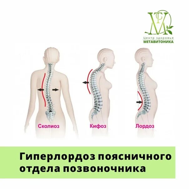 Гиперлордоз поясничного отдела норма. Гиперлордоз в пояснично-крестцовом отделе позвоночника. Правильное положение позвоночника сбоку. Гиперлордоз поясничного отдела позвоночника.