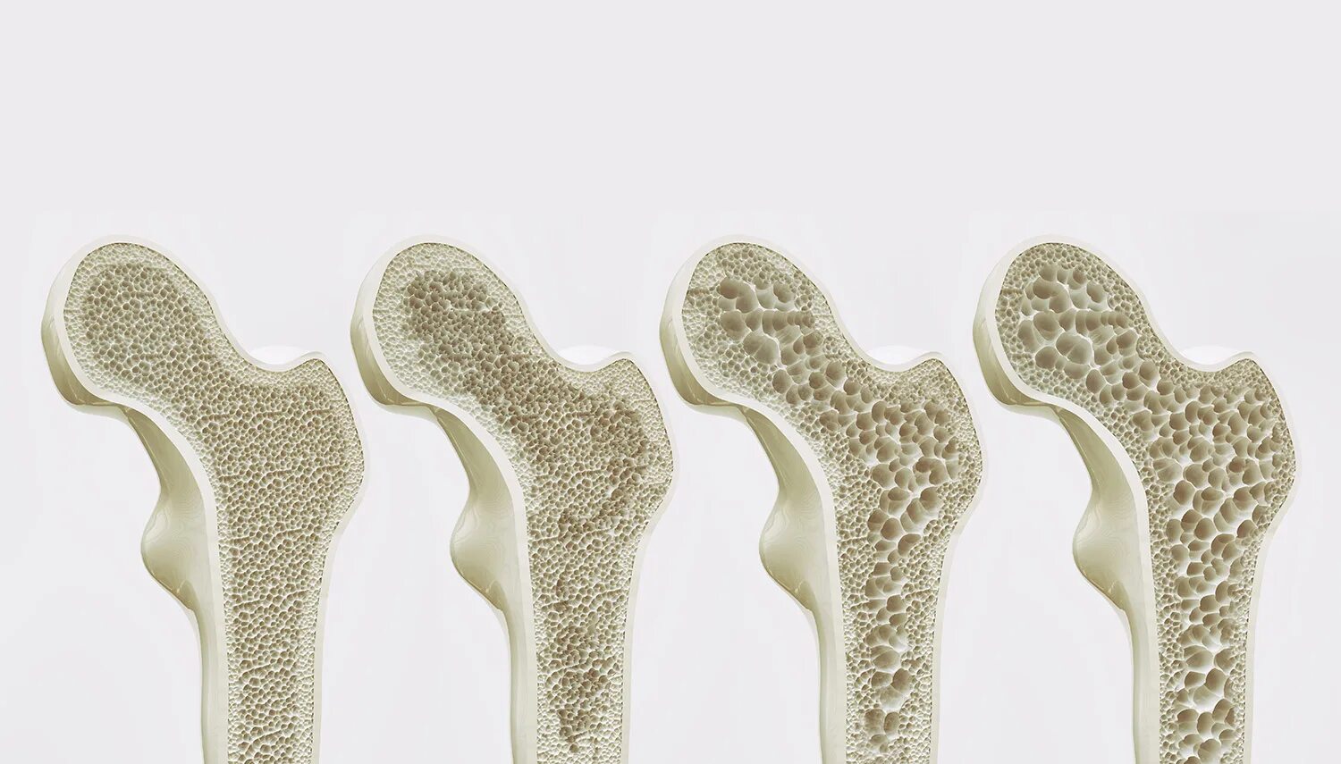 Как выглядит остеопороз. Нормальная кость и кость с остеопорозом. Плотность кости при остеопорозе. Как выглядит остеопороз. Остеопороз костей позвоночника.