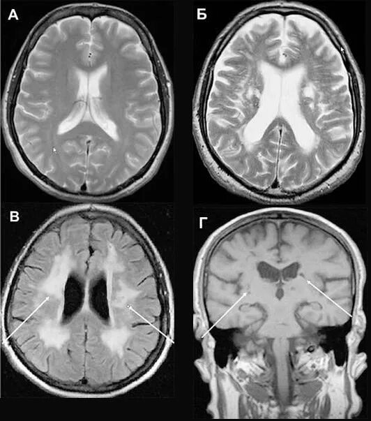 Патологии на мрт. Деменция на мрт головного мозга. Болезнь Бинсвангера на кт. Сосудистая энцефалопатия головного мозга на кт. Мультиинфарктная деменция.