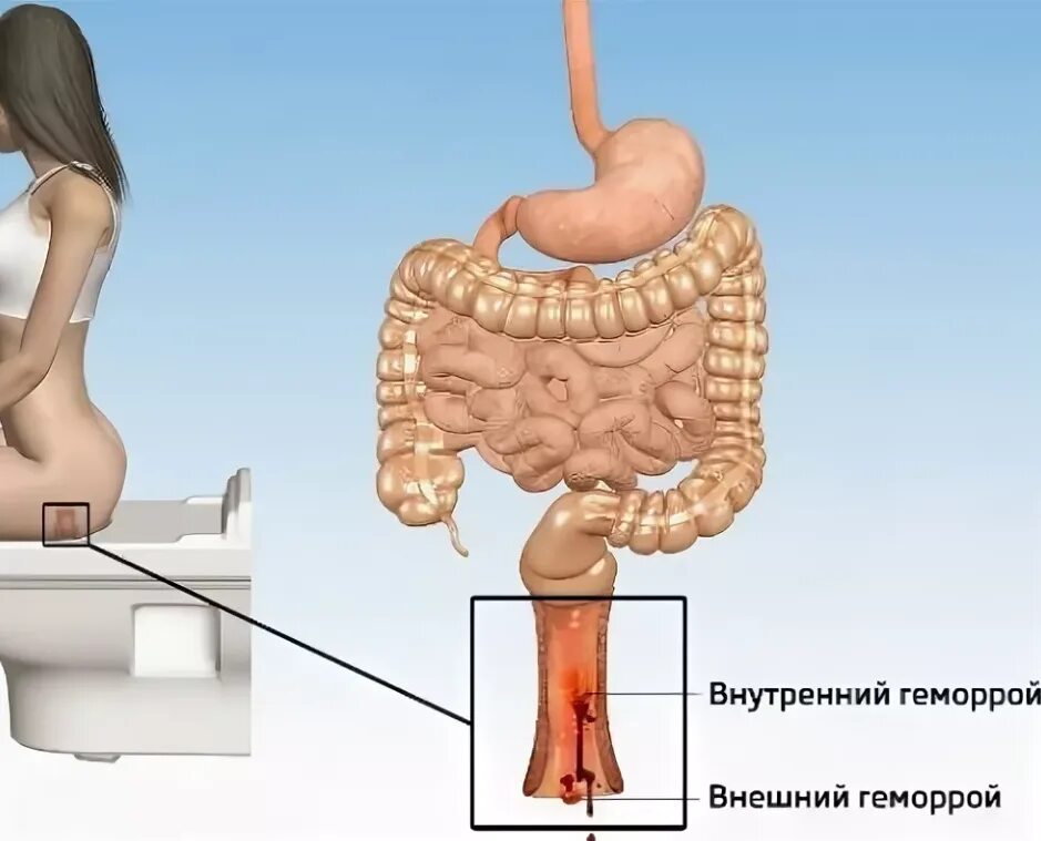 Дефекация при запоре. Строение кишечника запор. Узлы в прямом кишечнике. Физиологический запор.