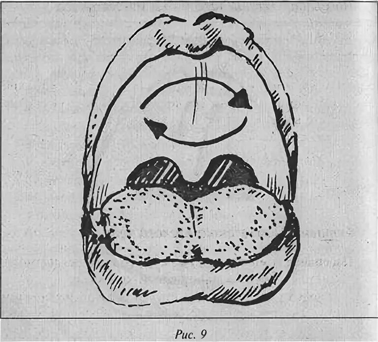 Поднятие мягкого неба. Массаж мягкого неба при ринолалии. Ринолалия небно глоточное смыкание. Массаж при ринолалии после операции. Массаж твердого и мягкого нёба.