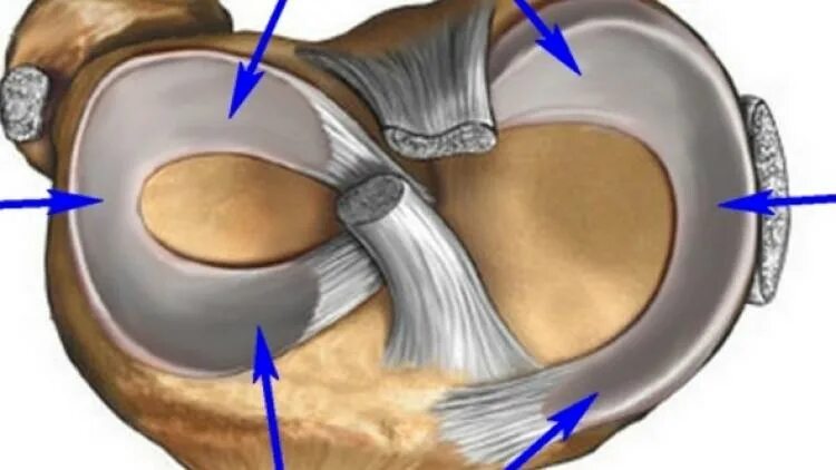 Разрыв медиальной. Мениски коленного сустава анатомия разрыв. Разрыв латерального мениска. Медиальный мениск коленного сустава. Травма мениска коленного сустава.