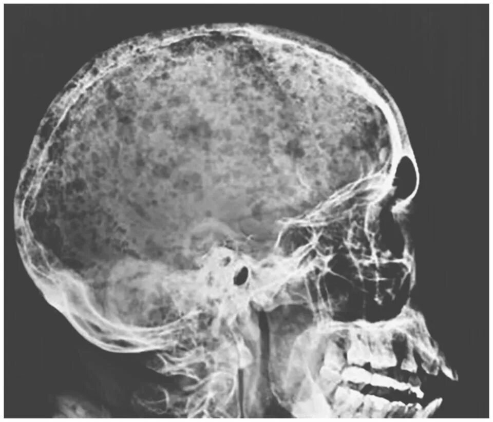 Кости черепа рентген. Миеломная болезнь рентген черепа. Миеломная болезнь череп. Миеломная болезнь кости черепа рентген. Множественная миелома рентген черепа.